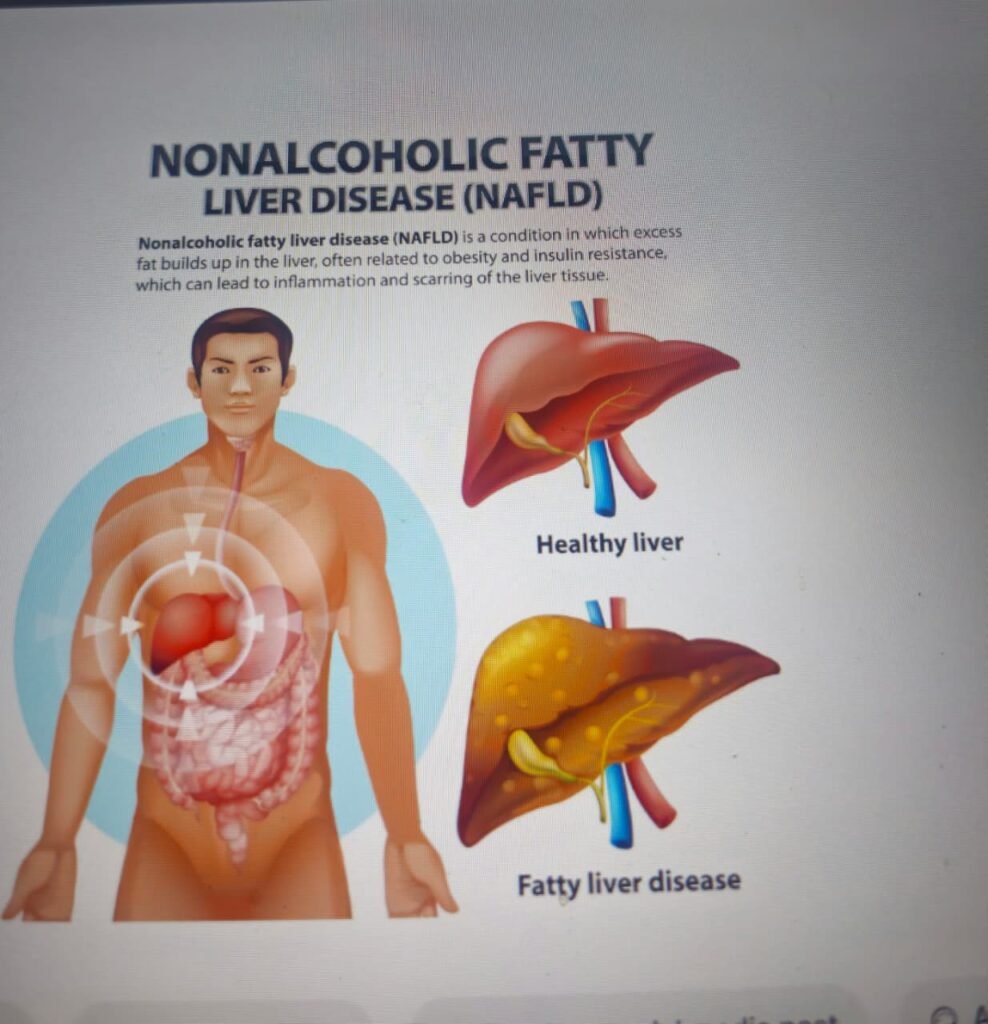 Nonalcoholic fatty liver disease - 6 ways to prevent damage in early stages 
