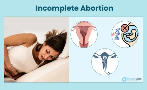 Incomplete Abortion: Causes, Symptoms, and Treatment