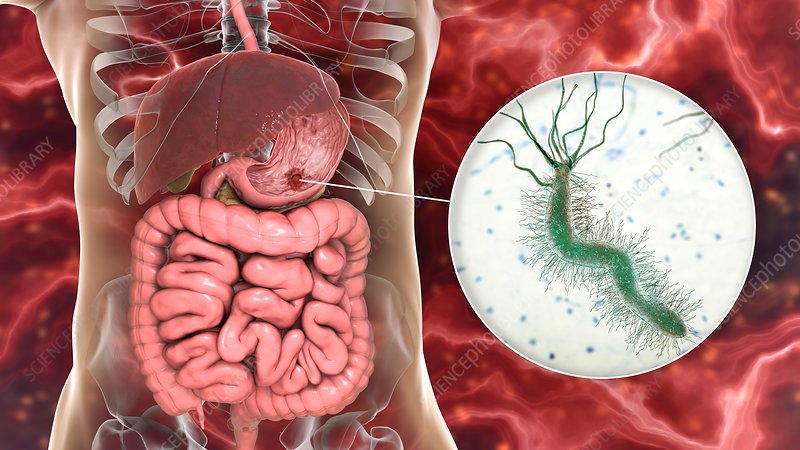 Understanding H. Pylori Bacteria